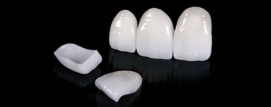 Ceramic Veneers